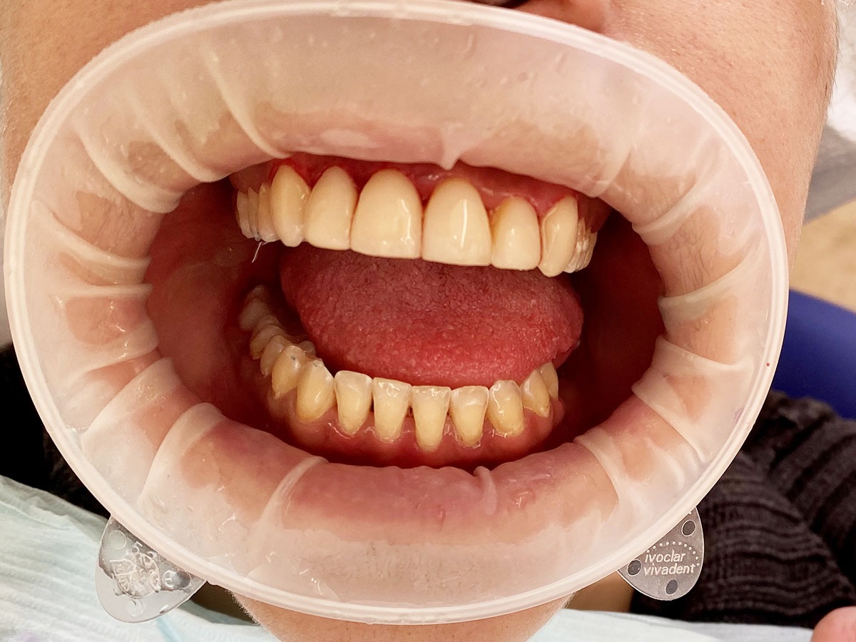 Gebitsrenovatie Before and After