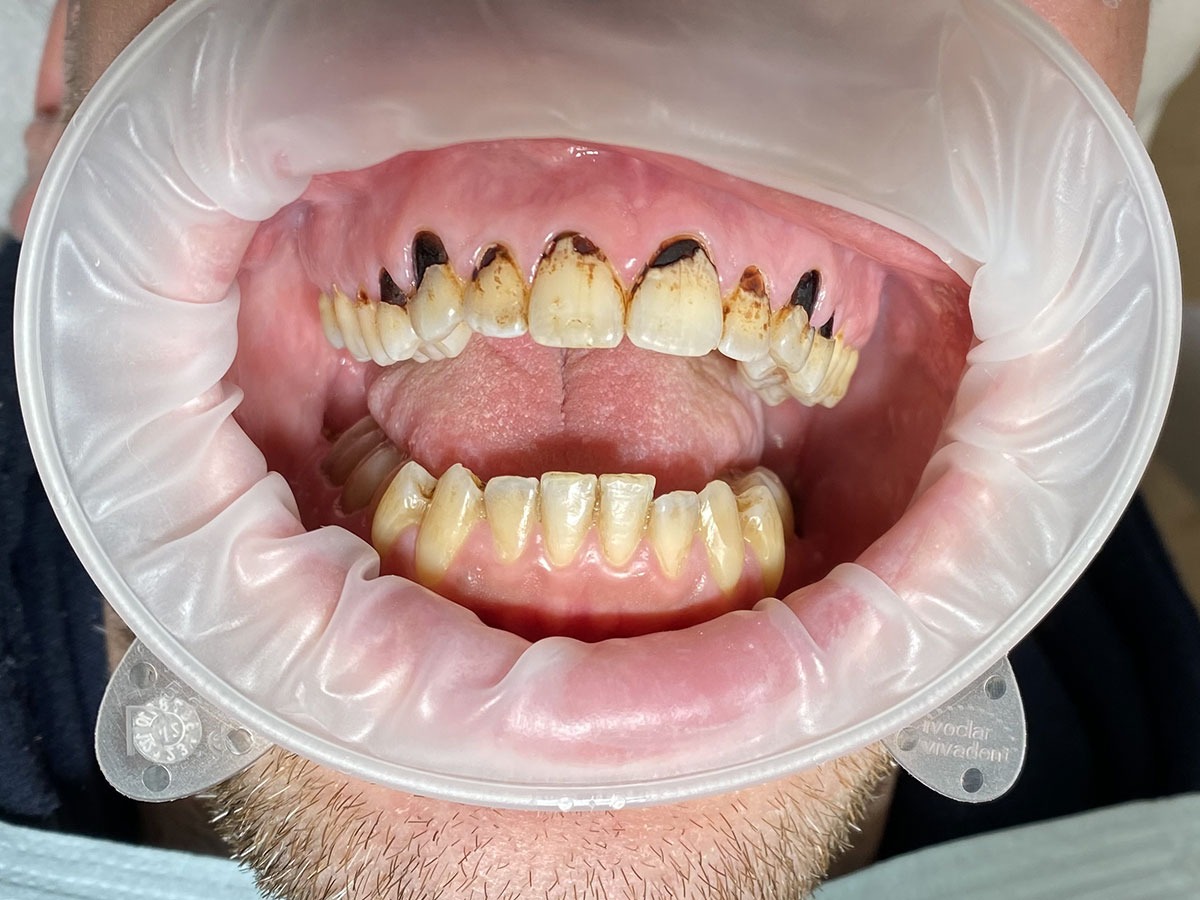 Gebitsrenovatie Before and After